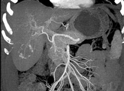 Hemangioma - CTisus CT Scan