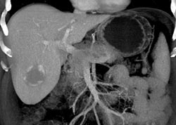 Hemangioma - CTisus CT Scan