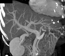 Fatty Liver - CTisus CT Scan