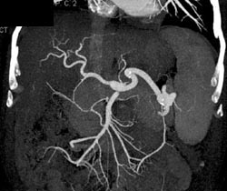 Cirrhotic Liver With Nice Hepatic Artery - CTisus CT Scan