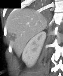 Hemangioma - CTisus CT Scan