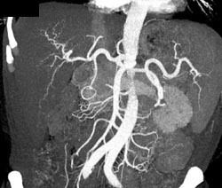 Hepatoma - CTisus CT Scan