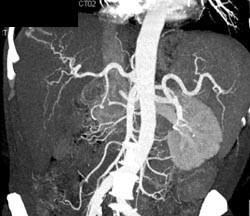 Hepatoma - CTisus CT Scan