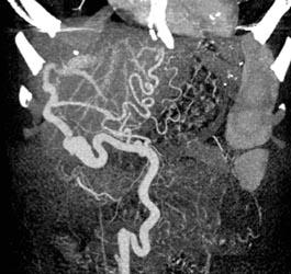 Cirrhosis With Varices - CTisus CT Scan