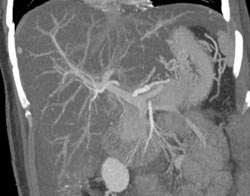 Fatty Liver With 1 Cm Hepatoma - CTisus CT Scan