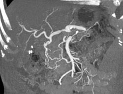 Normal Hepatic Artery - CTisus CT Scan