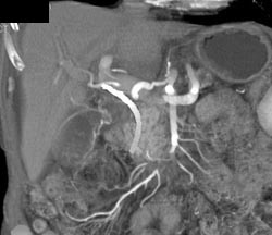 Hepatic Artery With Encasement - CTisus CT Scan