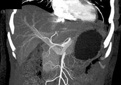 Normal Hepatic Artery - CTisus CT Scan