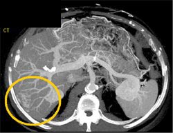 Hemangioma: Arterial and Venous Phases Using MIP - CTisus CT Scan