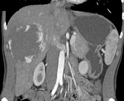 Hemangioma - CTisus CT Scan