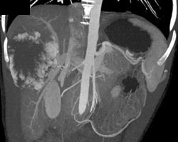 Hemangioma - CTisus CT Scan