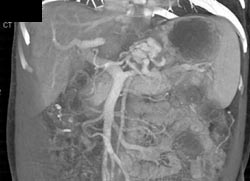 Cirrhosis With Varices - CTisus CT Scan