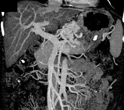 Cirrhosis With Varices - CTisus CT Scan