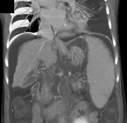 Cirrhosis - CTisus CT Scan