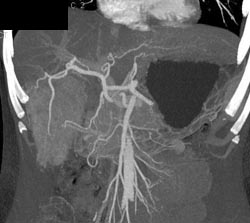 Cirrhosis With Hepatoma - CTisus CT Scan