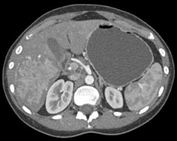 Hepatoma - CTisus CT Scan