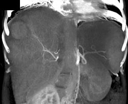 Hepatoma - CTisus CT Scan