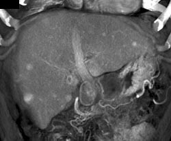 Regenerating Nodules - CTisus CT Scan