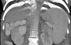 Cirrhosis With Varices - CTisus CT Scan