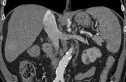 Hepatoma in A Cirrhotic Liver - CTisus CT Scan