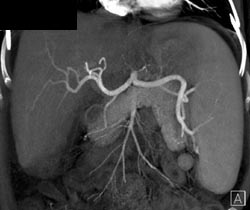 Cirrhosis - CTisus CT Scan