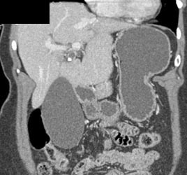 Distended Gallbladder and Stone in Neck C/w Mirizzi Syndrome - CTisus CT Scan