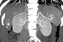 Hemangioma - CTisus CT Scan