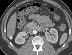 Hepatoma - CTisus CT Scan