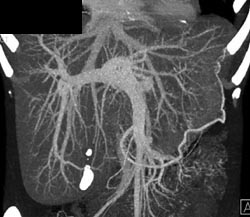 Hepatoma - CTisus CT Scan