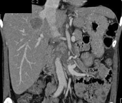 Hepatoma - CTisus CT Scan