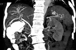 Cholangiocarcinoma - CTisus CT Scan