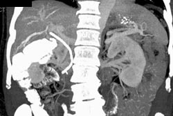 Cholangiocarcinoma - CTisus CT Scan