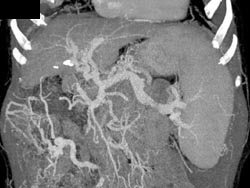 Cirrhosis With Varices - CTisus CT Scan