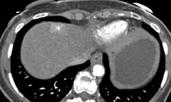 Hemangioma - CTisus CT Scan