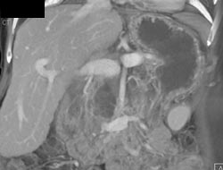 Patent Portal Vein - CTisus CT Scan