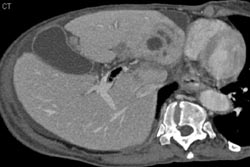 Air in Portal Vein (infection) - CTisus CT Scan