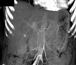 Hemangioma (1 Cm) - CTisus CT Scan