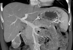 Cirrhosis - CTisus CT Scan