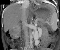 Varices Near Kidney - CTisus CT Scan