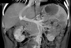 Transjugular Intrahepatic Portosystemic Shunt (TIPS) Catheter - CTisus CT Scan