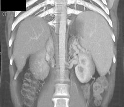 Cirrhosis With Varices Near Left Kidney - CTisus CT Scan