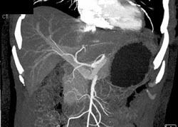 Normal Hepatic Artery - CTisus CT Scan