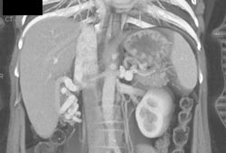 Cirrhosis With Varices Near Right Kidney - CTisus CT Scan