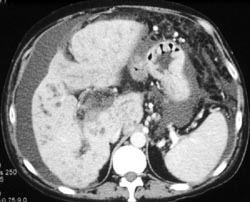 Cirrhosis With Cholangitis - CTisus CT Scan