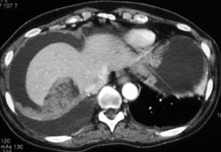 Hepatic Infarct and Abscess - CTisus CT Scan