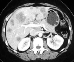 Liver Metastases and Nodes in Porta - CTisus CT Scan