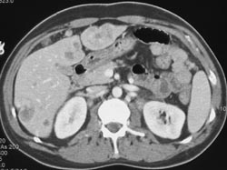 Implants on Liver Surface and Liver Metastases - CTisus CT Scan