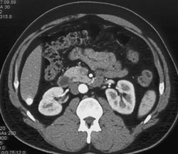 Hepatoma - CTisus CT Scan