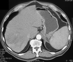 Metastases From Renal Cell Carcinoma - CTisus CT Scan