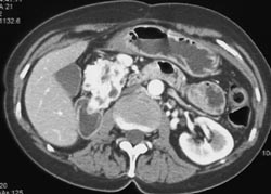 Metastases to Pancreas From Renal Carcinoma - CTisus CT Scan